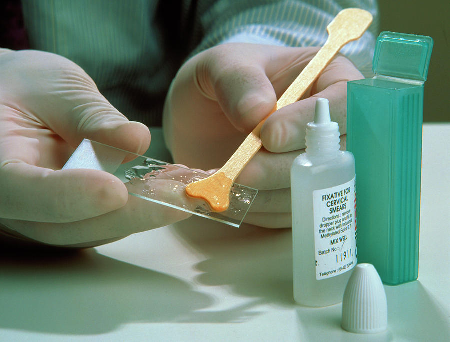 Close-up Of Cervical Smear Being Fixed On Slide Photograph by Saturn ...