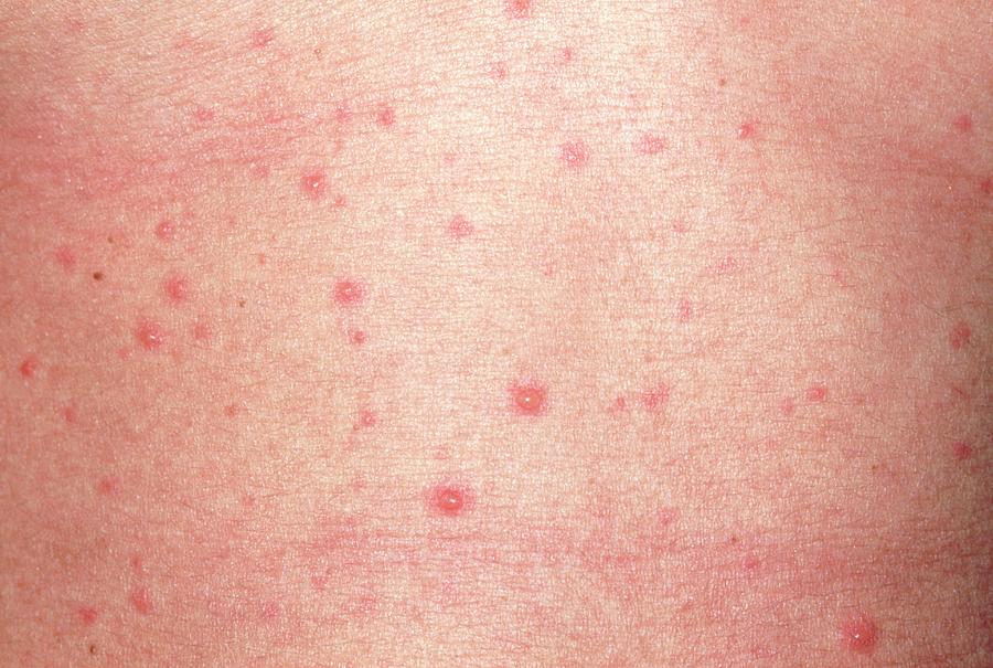 Close-up Of Chickenpox Vesicles On The Skin Photograph by Dr P. Marazzi ...