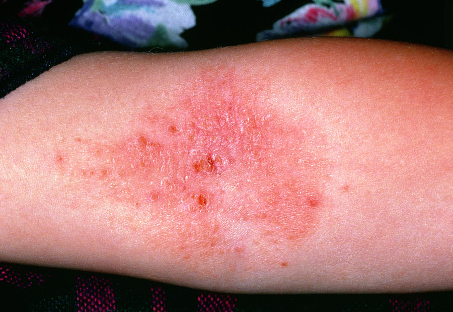Close Up Of Eczema In The Crook Of The Elbow Photograph By Dr Hc