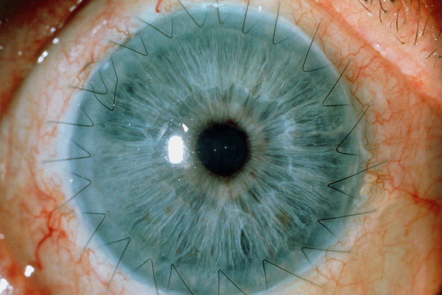 Close-up Of Eye Showing Corneal Graft by Argentum/science Photo Library