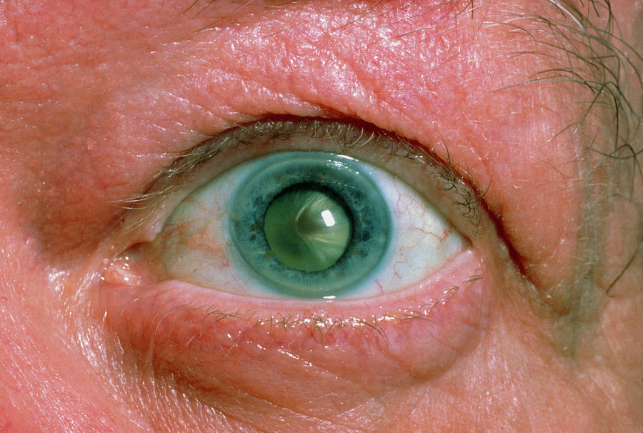 Close-up Of Patient's Eye With Trauma Cataract Photograph by Sue Ford ...