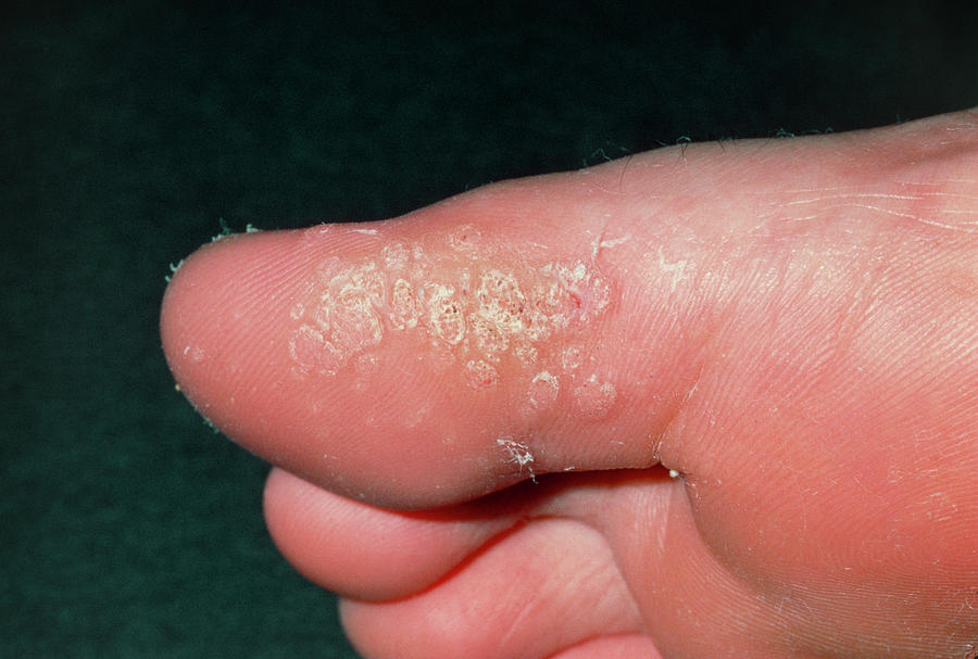 Close Up Of Plantar Warts On Big Toe Photograph By Dr P Marazzi Science Photo Library