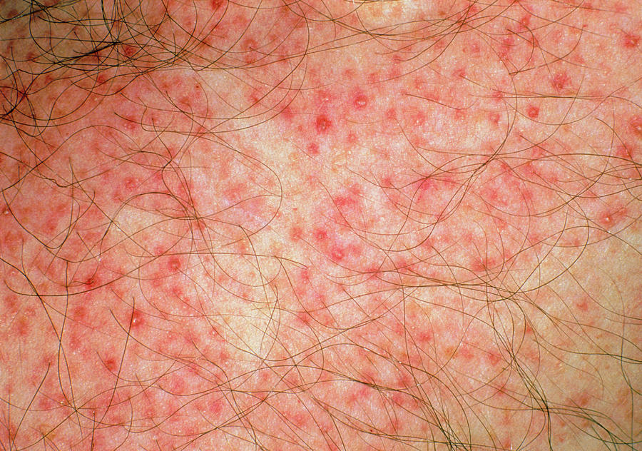 Folliculitis Photograph - Close-up Of Red Folliculitis Papules On Skin by Dr. Chris Hale/science Photo Library