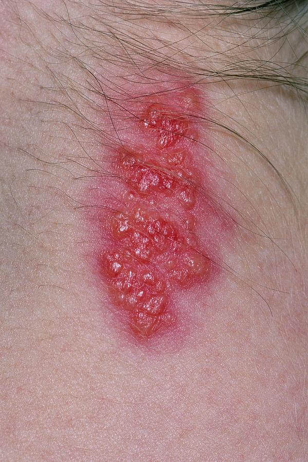 Close Up Of Shingles Rash On Back Of Womans Neck Photograph By Dr P