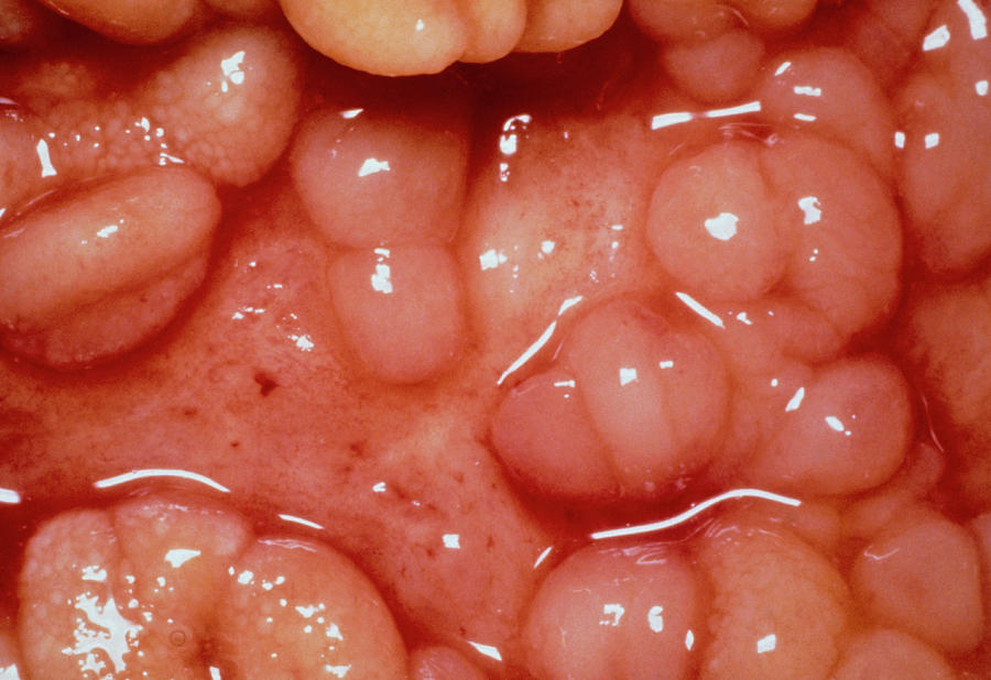 Crohn's Disease Photograph - Close-up Of Small Intestine In Crohns Disease by Biophoto Associates/science Photo Library