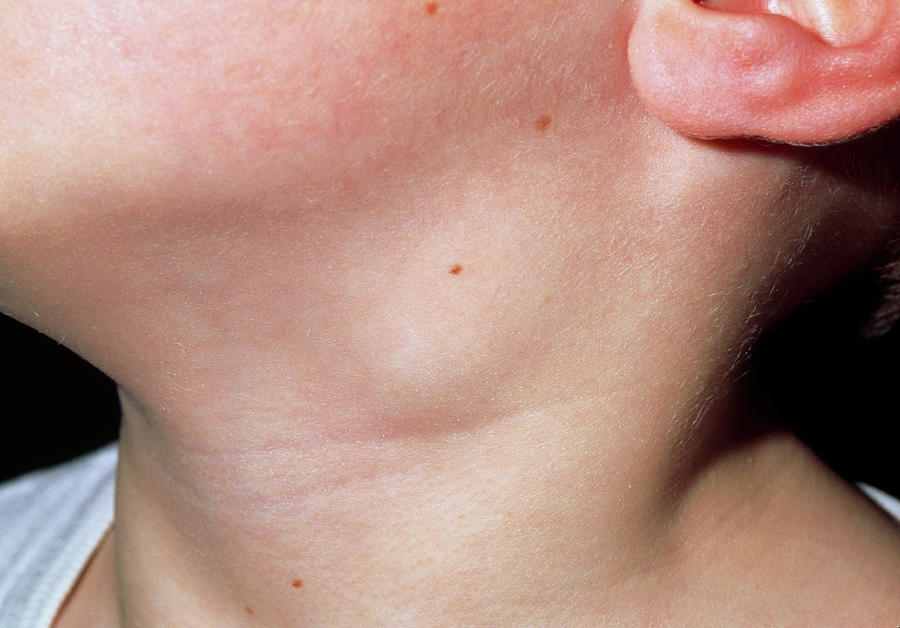 Close up Of Swollen Lymph Node In The Neck Of Boy Photograph By Dr P 