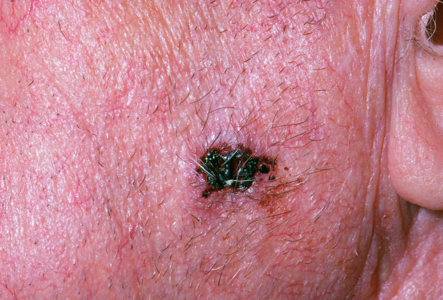 Close Up Showing A Basal Cell Carcinoma On Face Photograph By Dr P Marazziscience Photo Library 7108