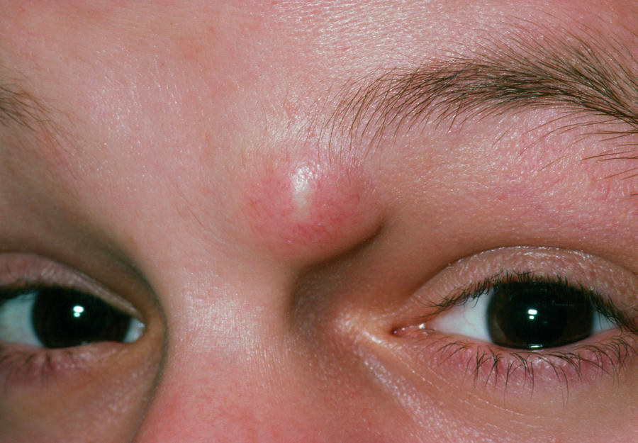 Close Up Showing A Sebaceous Cyst In Eyebrow Photograph By Dr P Marazziscience Photo Library 