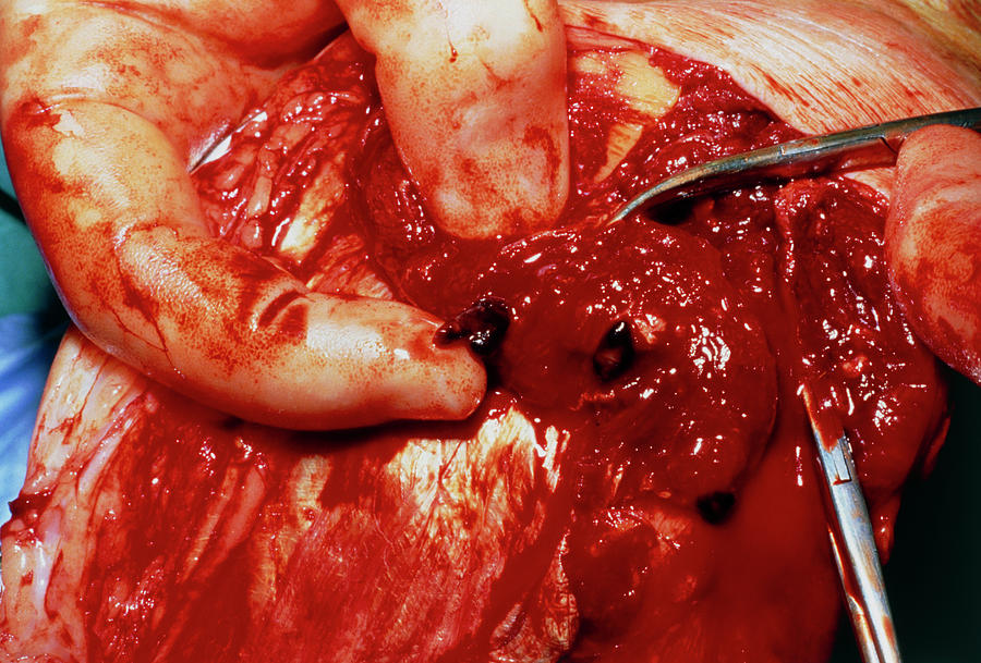 Closeup Showing Thrombi In Deep Vein Thrombosis