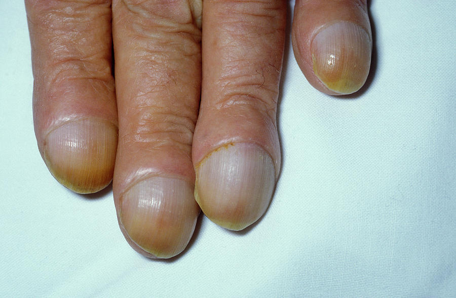 Clubbed fingers: Causes, symptoms, treatment, and when to seek help