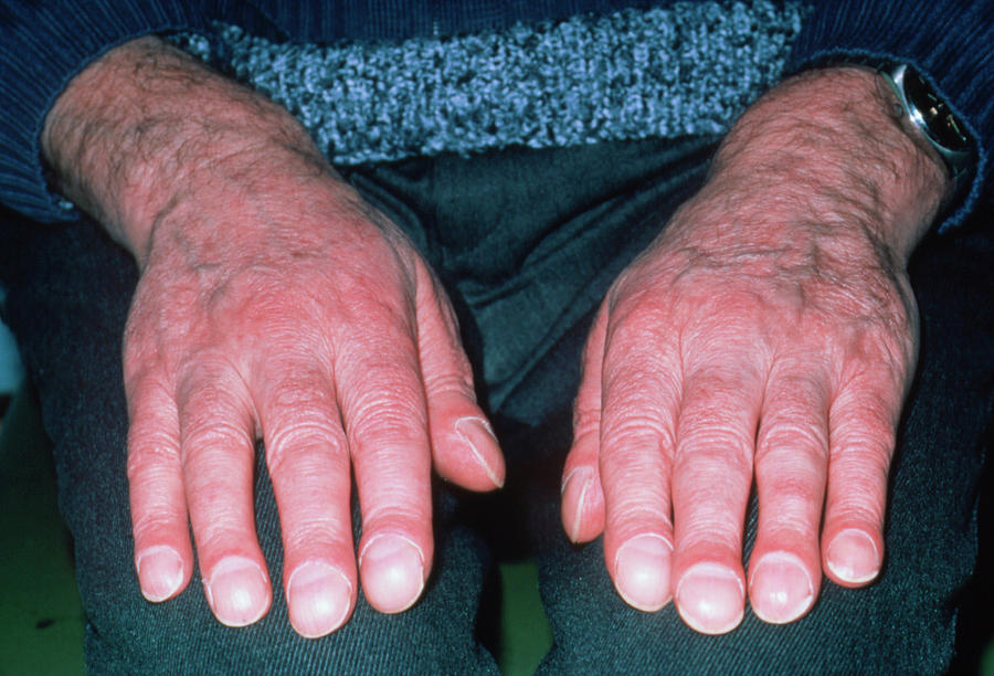Clubbing (acropachy) Of Finger Tips Photograph by Sue Ford/science Photo Library
