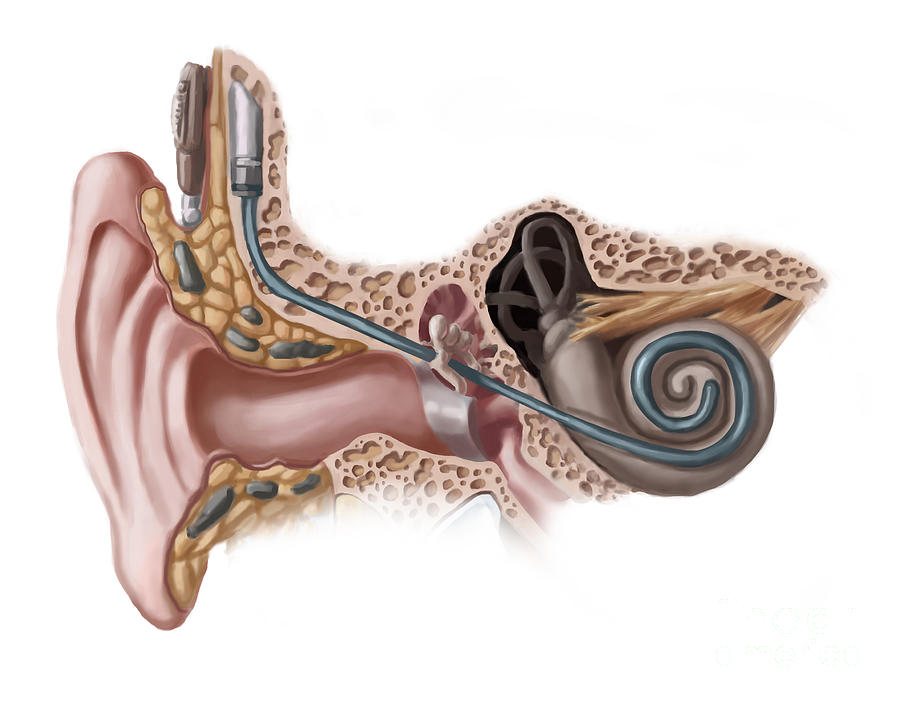 Cochlear Implant, Illustration Photograph by Spencer Sutton