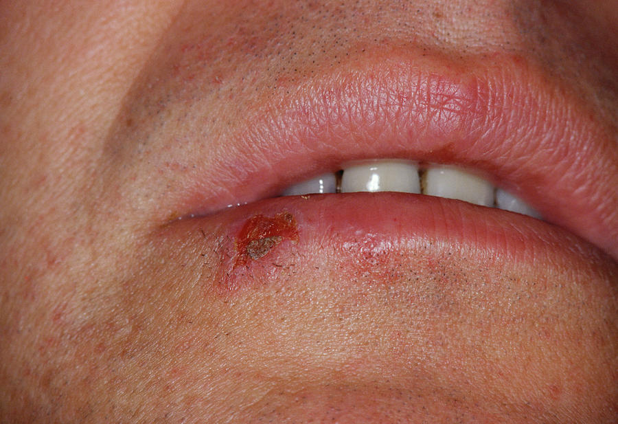 Cold Sore Photograph By Cnriscience Photo Library Pixels