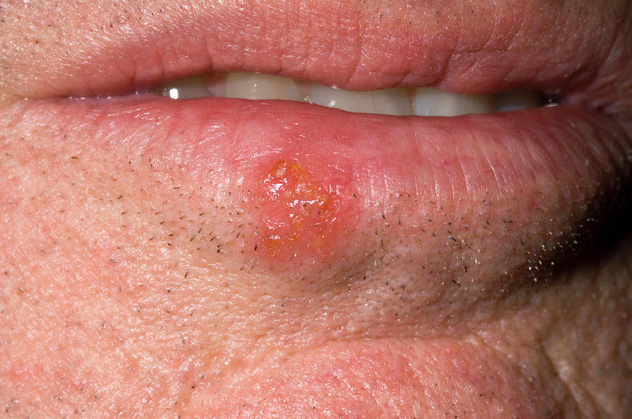 Cold Sore Lesion Photograph by Dr P. Marazzi/science Photo Library