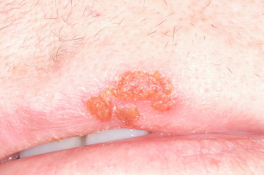 cold-sore-lesion-on-upper-lip-photograph-by-dr-p-marazzi-science-photo