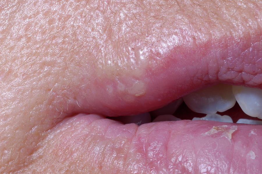 Cold Sores (herpes Simplex) On The Lips Photograph by Dr P. Marazzi