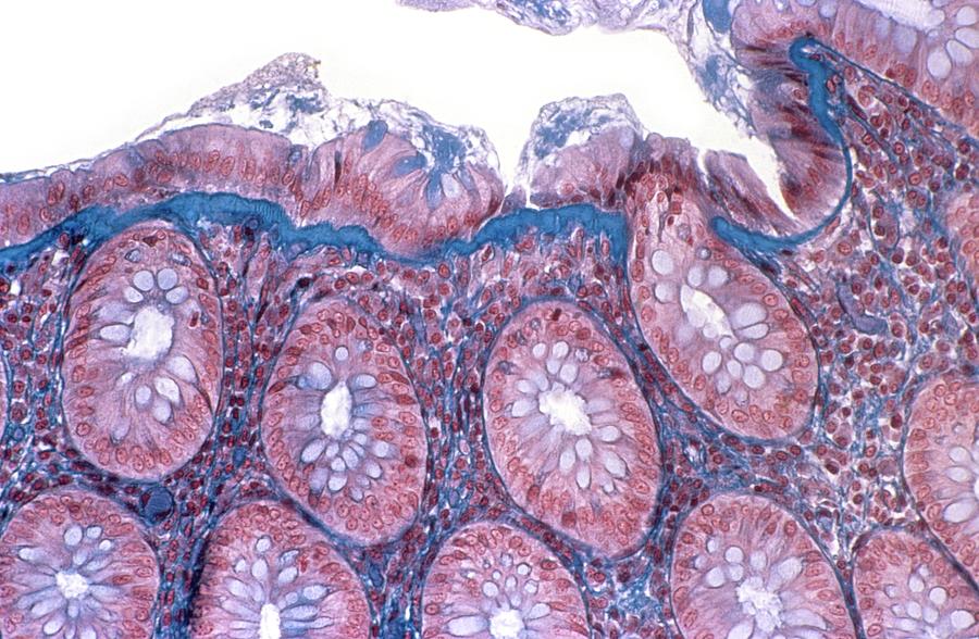 Collagenous Colitis Photograph by Cnri/science Photo Library