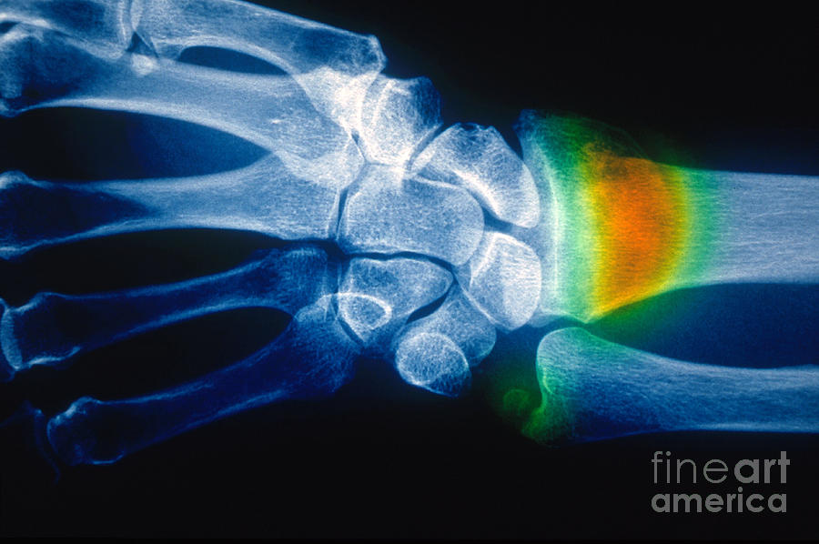 Colles Fracture, X-ray Photograph by Scott Camazine