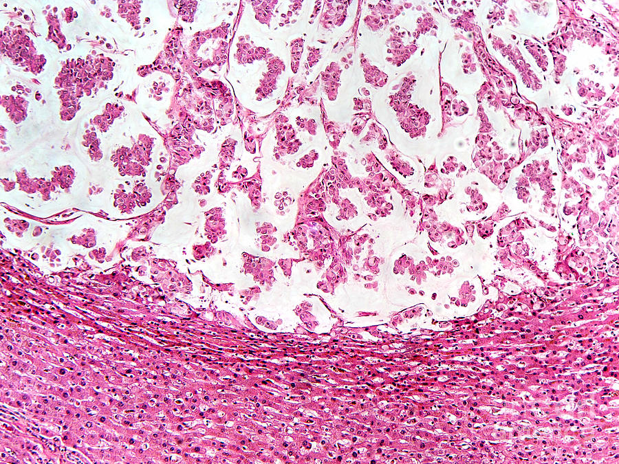 Colloid Liver Tumor, Lm Photograph by Garry DeLong