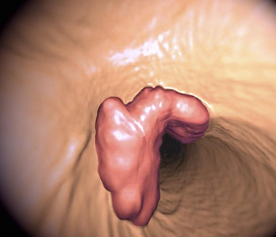 Anatomy Photograph - Colon cancer, 3D colonoscopy image by Science Photo Library