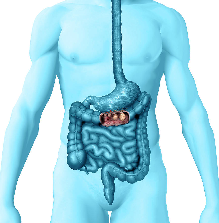 Colon Cancer Photograph - Colon Cancer by Carol & Mike Werner
