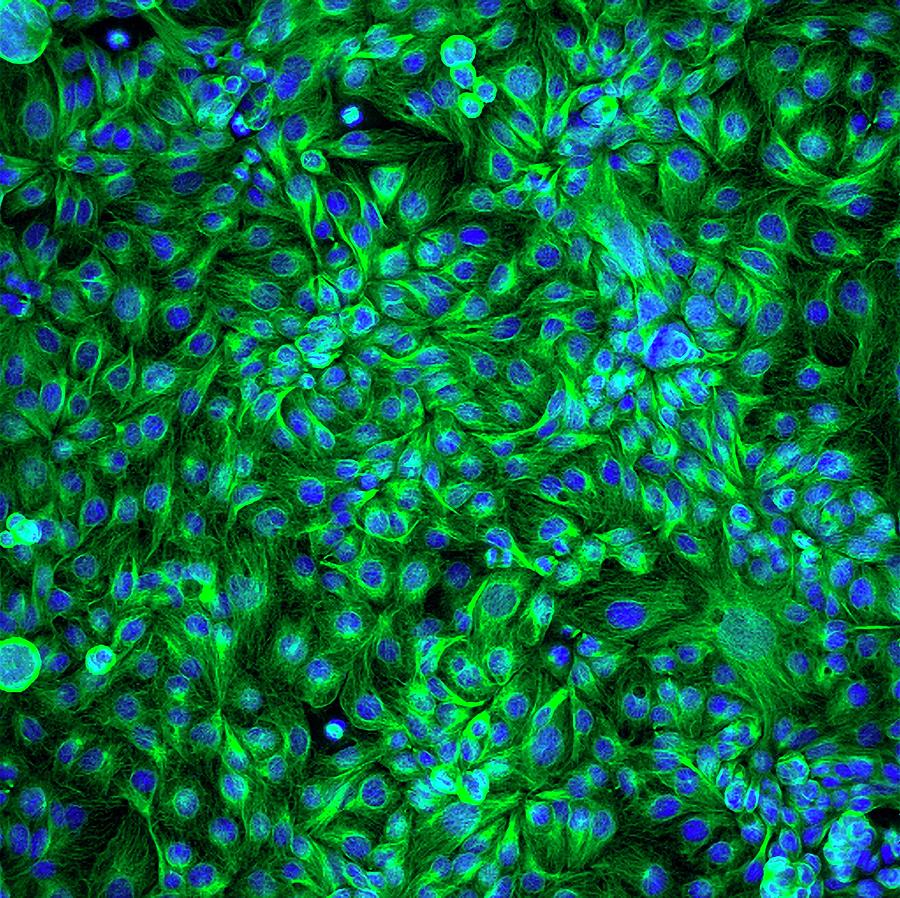 Colon Cancer Photograph - Colon Cancer Cells by Ammrf, University Of Sydney