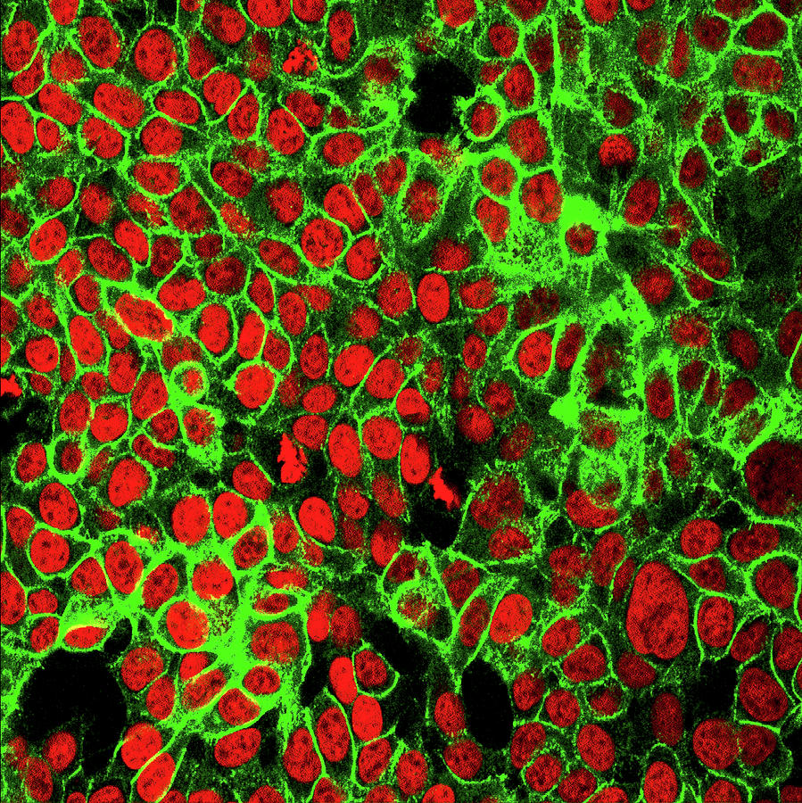 Colon Cancer Cells Photograph by Nci Center For Cancer Research/national Cancer Institute/science Photo Library