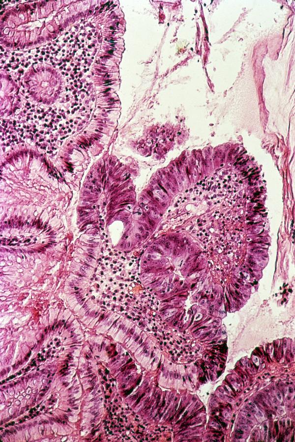 Disease Photograph - Colon Cancer by Cnri
