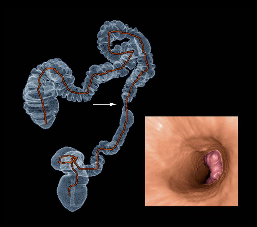 Anatomy Photograph - Colon cancer, CT scans by Science Photo Library