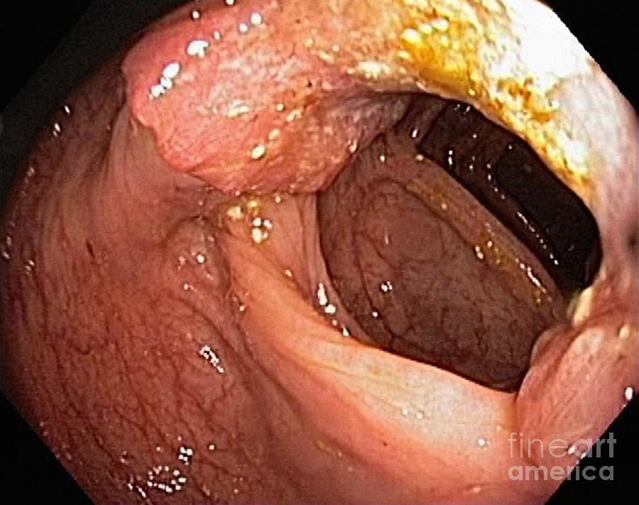 Digestive System Photograph - Colon Cancer, Endoscopic View by Gastrolab