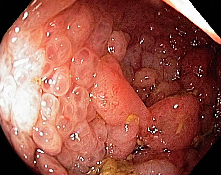 endoscopy for colon cancer