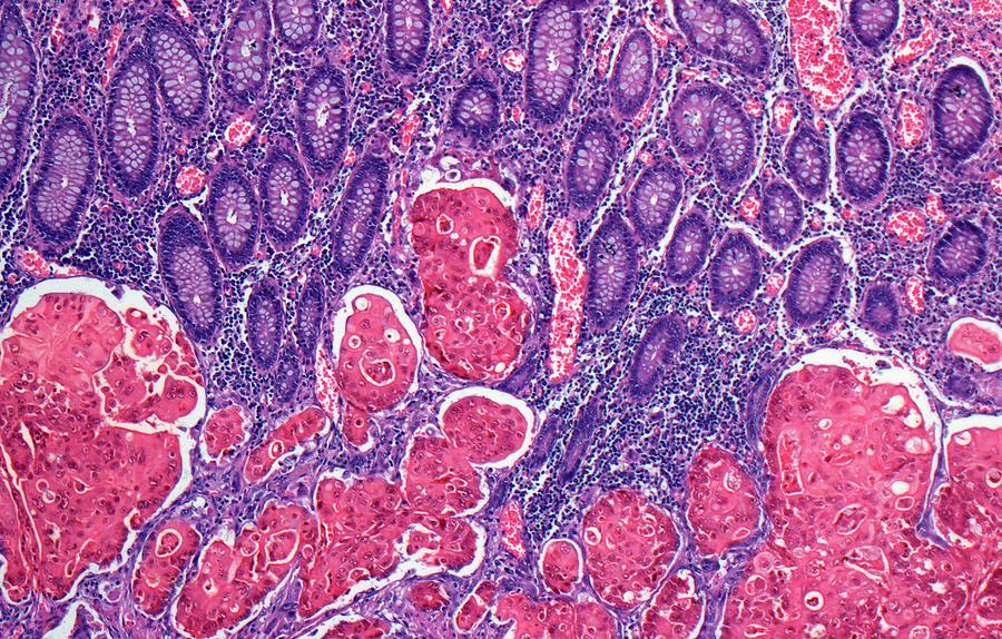 Colon Cancer Photograph by Steve Gschmeissner/science Photo Library