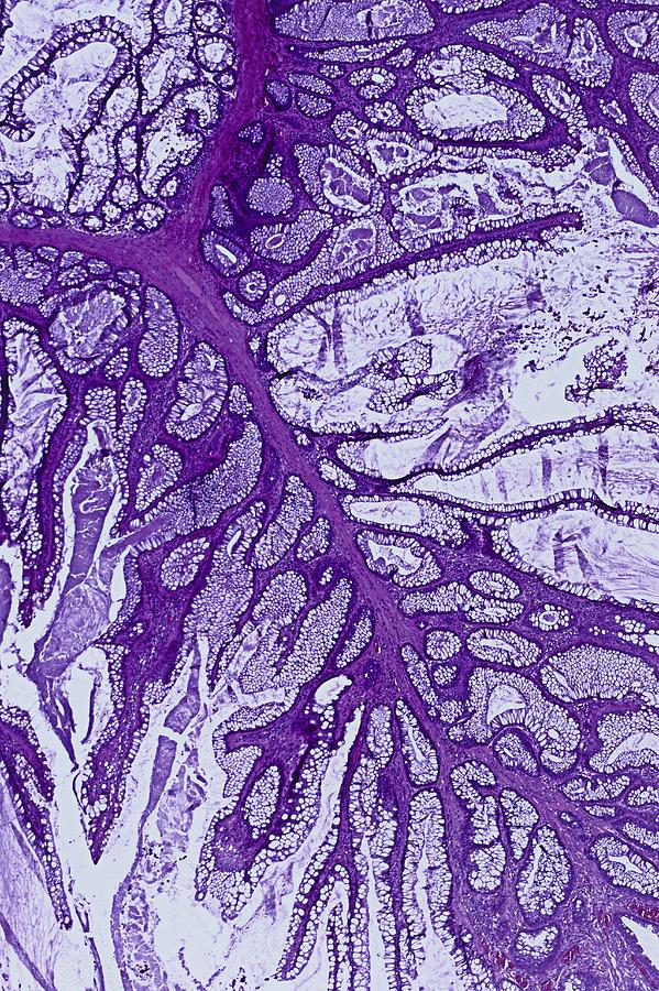 Colon polyp, light micrograph Photograph by Science Photo Library - Pixels