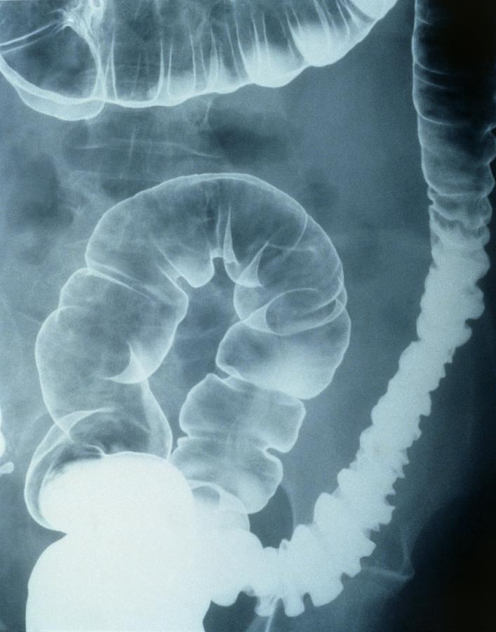 Colonic spasm, Xray Photograph by Science Photo Library Fine Art America