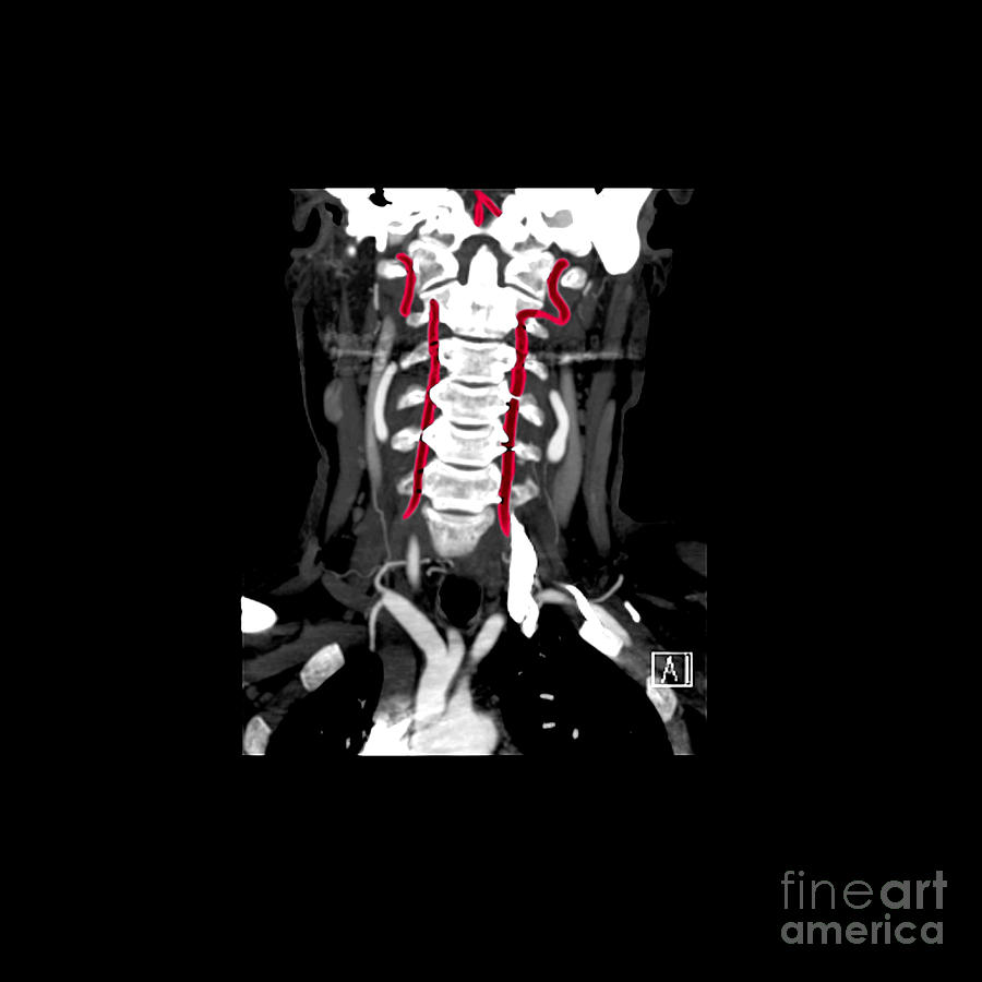 Ct Angiogram Photograph - Color Enhanced Cta Of Vertebral Arteries by Living Art Enterprises, LLC
