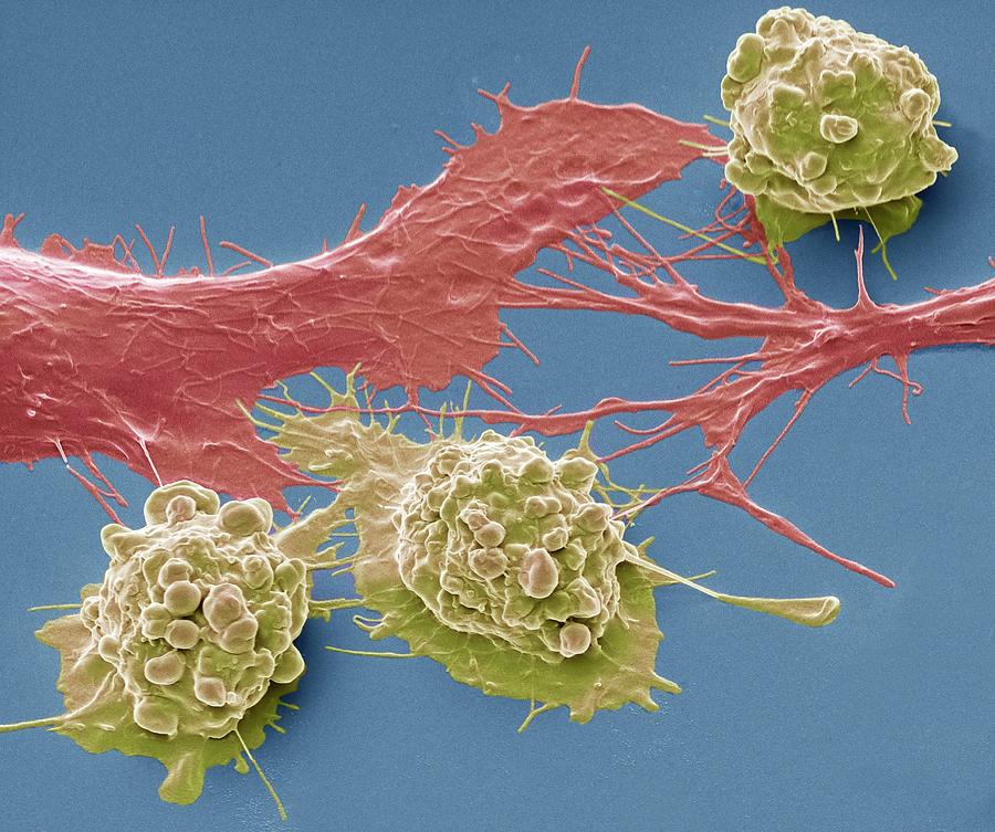 Abnormal Photograph - Colorectal Cancer Cells by Steve Gschmeissner