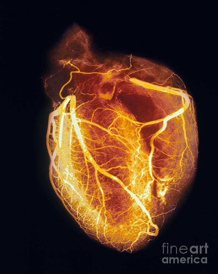 Colored arteriogram of arteries of healthy heart Photograph by Spl