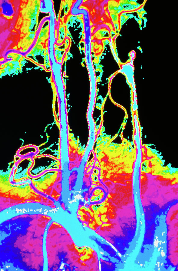 Colour Angiogram Of Arteries In The Human Neck Photograph by Gca/science Photo Library