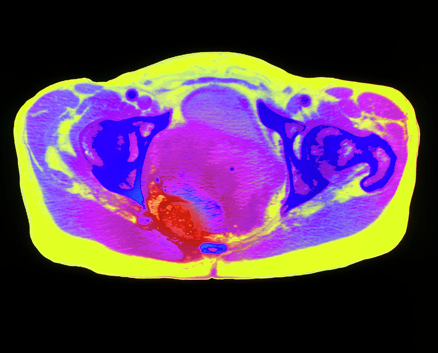 Colour Ct Scan Of Uterine Cancer Leiomyosarcoma Photograph By Science