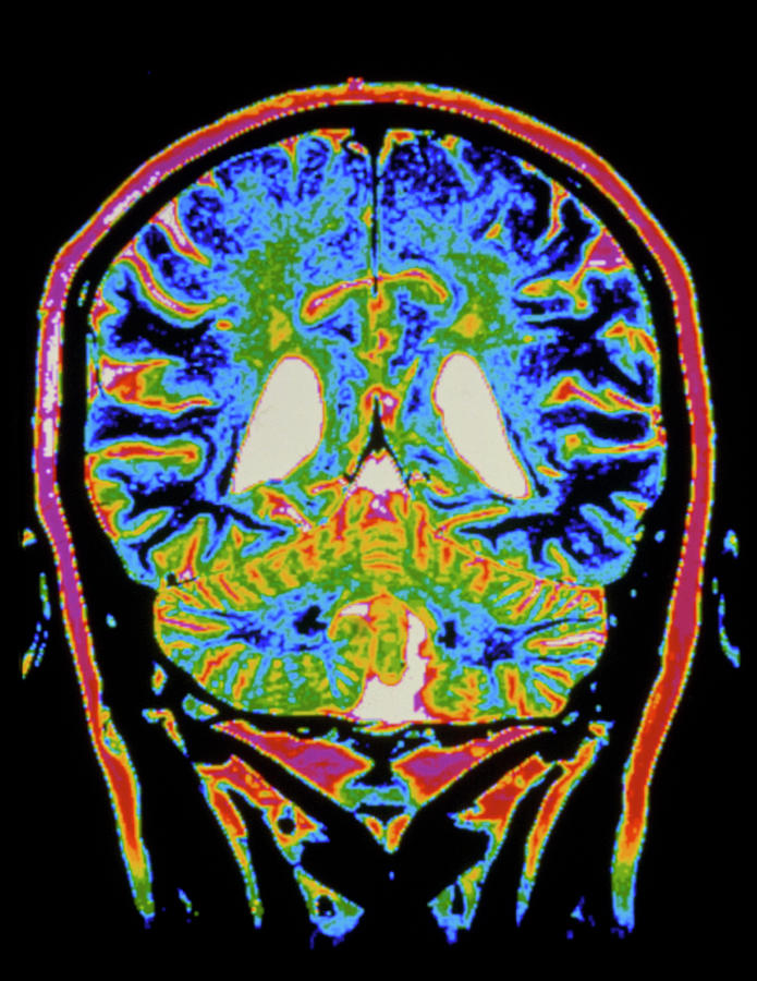 Colour Mri Scan Of A Brain With Multiple Sclerosis Photograph by Gca/science Photo Library