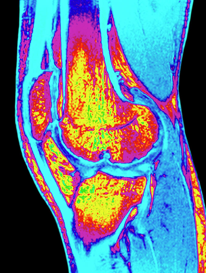 Colour Mri Scan Of Knee Joint With Osteoarthritis Photograph by Simon Fraser, Royal Victoria Infirmary/ Science Photo Library