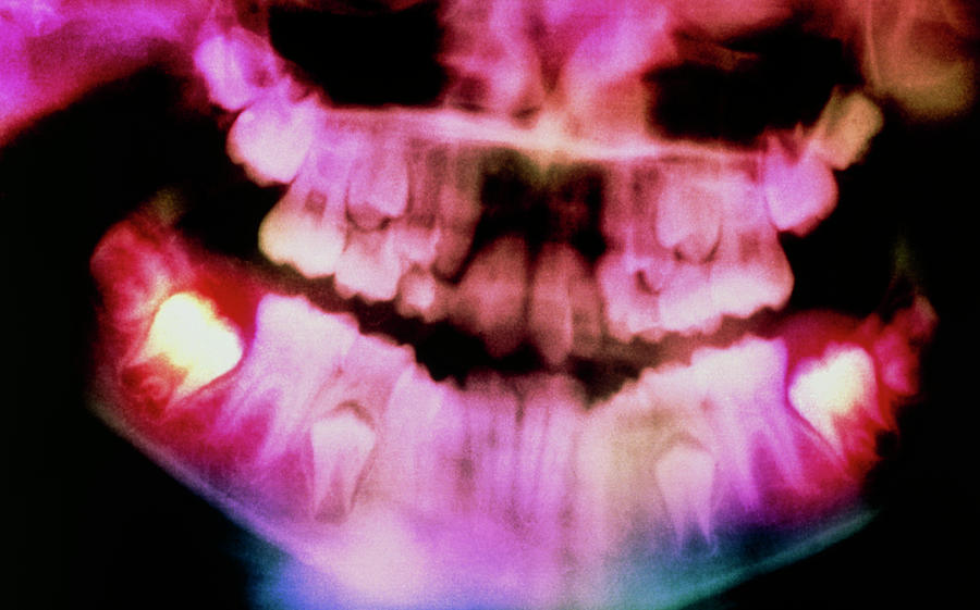 Colour Pan-oral X-ray Of Erupting Molars In Child Photograph by Science Photo Library