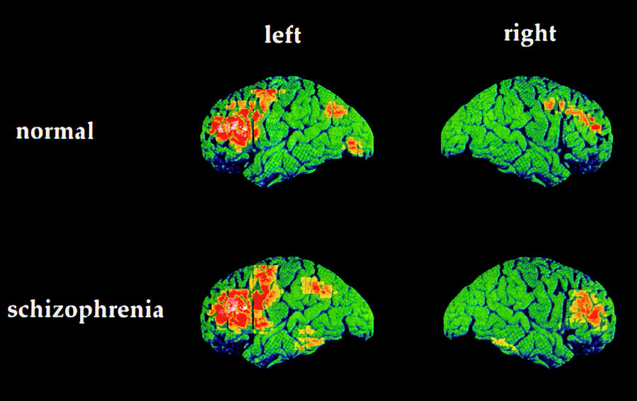 Colour Pet Brain Scans Of Schizophrenic Speaking Photograph by Wellcome Dept. Of Cognitive Neurology/ Science Photo Library