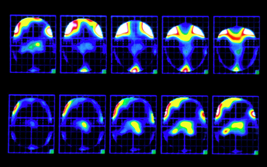 Angina Pectoris Photograph - Colour Pet Brain Scans Showing Pain During Angina by Mrc Cyclotron Unit/science Photo Library