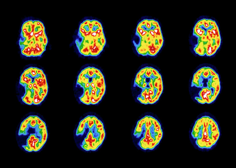 Colour Pet Scans Of The Brain Of A Stroke Patient Photograph by Dept. Of Cognitive