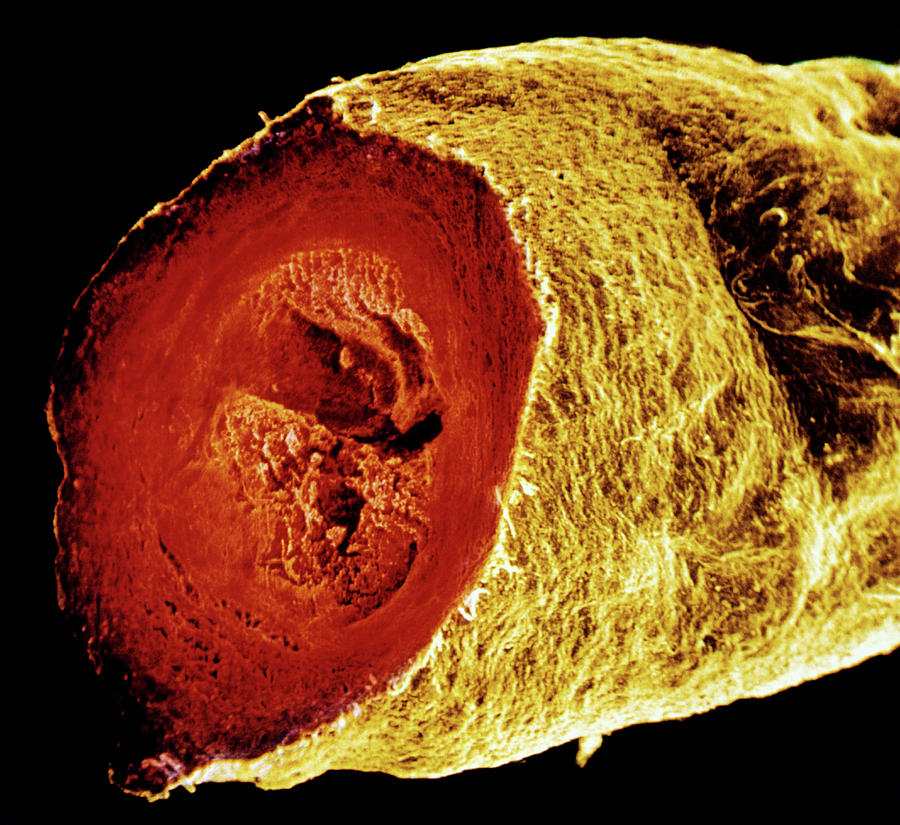 Colour Sem Of A Sectioned Varicose Saphenous Vein Photograph by Alain ...