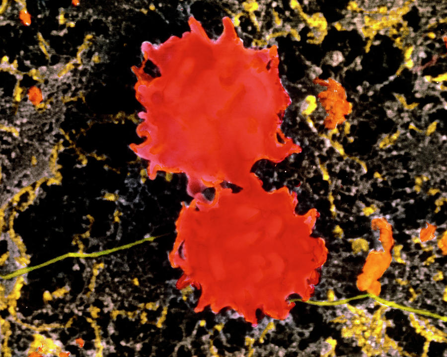 Echinocyte Photograph - Colour Sem Of Echinocytes (blood) In Gastric Ulcer by Prof. P. Motta/dept. Of Anatomy/university \la Sapienza\, Rome/science Photo Library