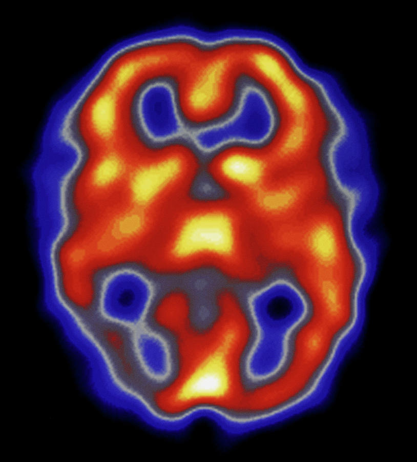 Migraine Photograph - Colour Spect Scan Of Brain During Migraine Attack by Dept. Of Nuclear Medicine, Charing Cross Hospital/science Photo Library