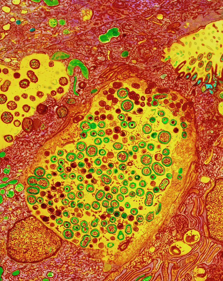 Colour Tem Of Fallopian Cells In Chlamydia Infect. Photograph by Dr R ...