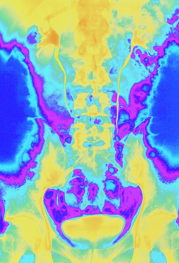 Pyelogram Photograph - Colour X-ray Of Healthy Kidneys by Mehau Kulyk/science Photo Library Pyelogram Photograph - Colour X-ray Of Healthy Kidneys by Mehau Kulyk/science Photo Library